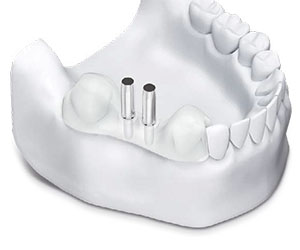 anwendung-dentale-bohrschablone-_0007_step-5.jpg