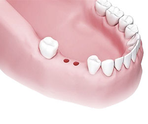 anwendung-dentale-bohrschablone-_0000_step-12.jpg
