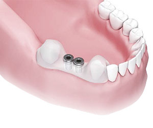 anwendung-dentale-bohrschablone-_0004_step-8.jpg