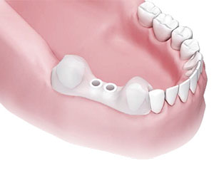 anwendung-dentale-bohrschablone-_0005_step-7.jpg