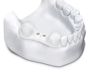 anwendung-dentale-bohrschablone-_0006_step-6.jpg