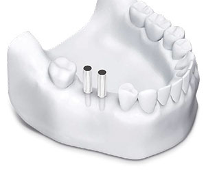 anwendung-dentale-bohrschablone-_0010_step-2.jpg