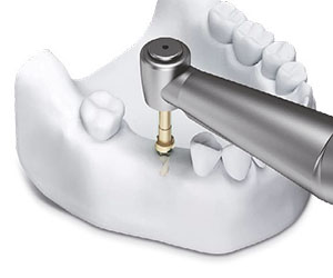 anwendung-dentale-bohrschablone-_0011_step-1.jpg