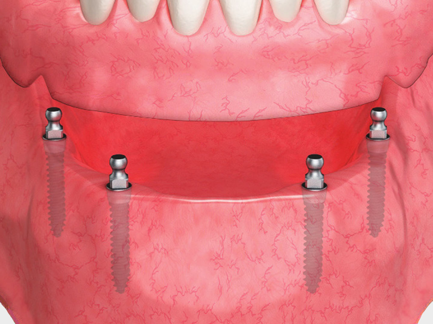 denture-ms-implant.jpg