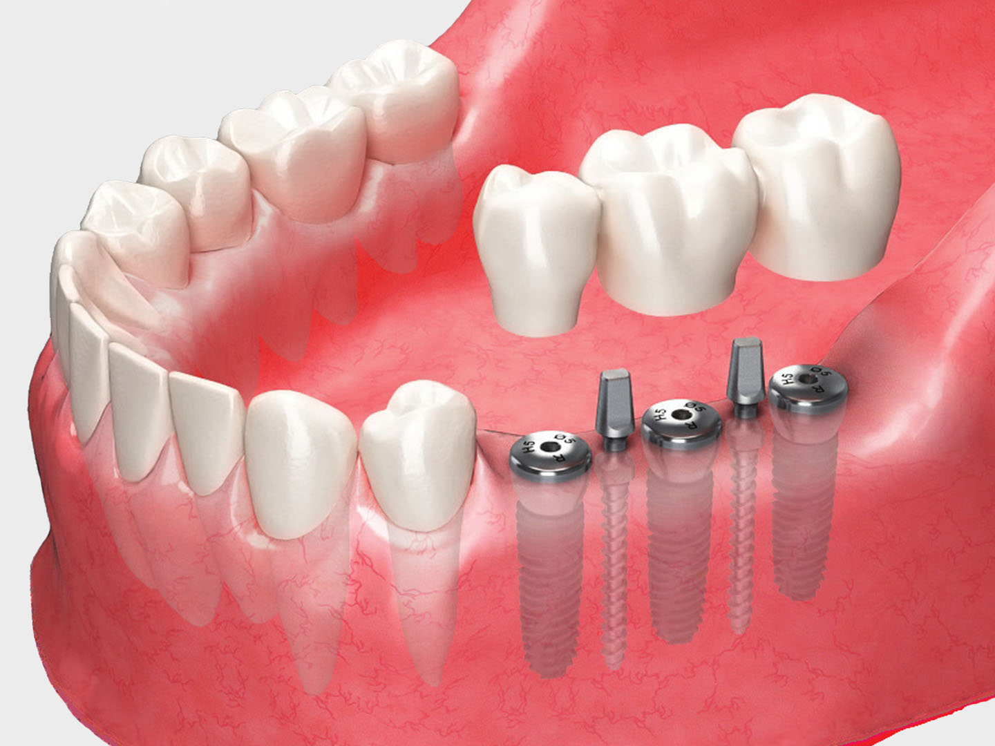 provisional-implant-ms-system.jpg
