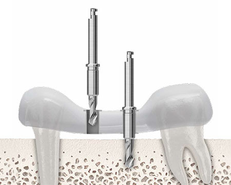 stable-drilling-path-dental-guide.jpg
